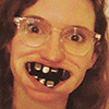 me wearing glasses looking at the camera with rows of hematite in my mouth that look like large, gray teeth